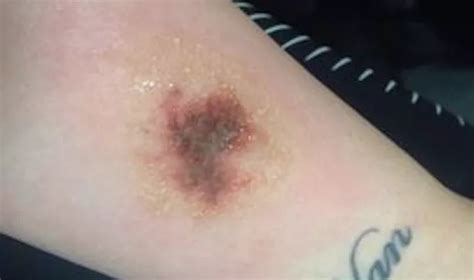 mum splashed with oven cleaner thought skin was rotting away when it bubbled and turned black