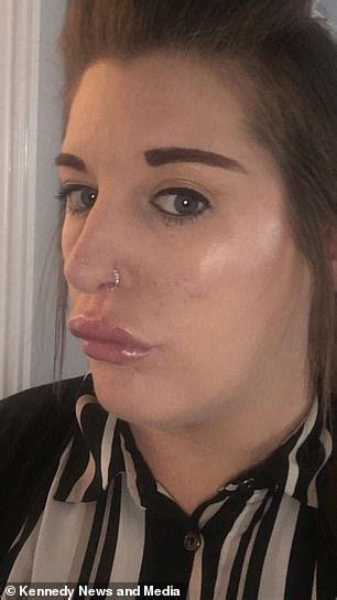 Mother Claims Botched Lip Filler Left Her With Duck Lips And Blood Dripping Down Her Face