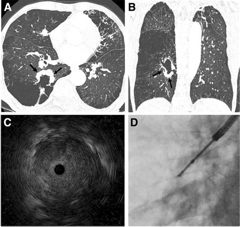 Representative Case Of Ebus Gs In A Patient With Severe Pulmonary