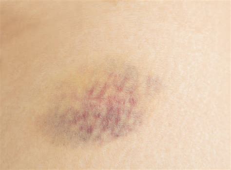80 Hematoma Thigh Stock Photos Pictures And Royalty Free Images Istock
