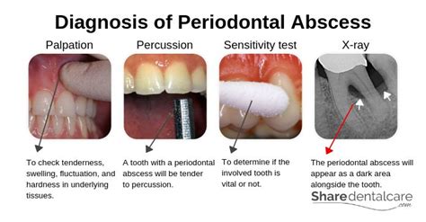 Periodontal Abscess Symptoms And Causes With Pictures