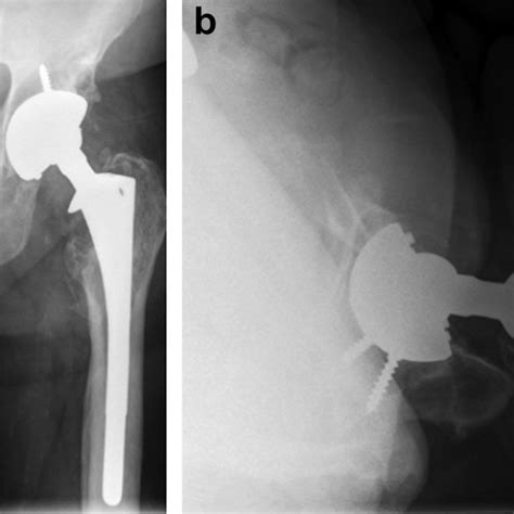 Anteroposterior Ap Pelvis A And Lateral Hip Radiograph B Showing
