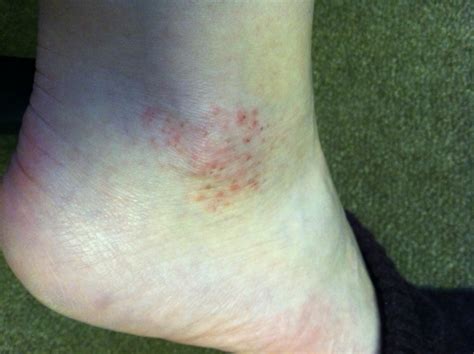 I Have A Red Rash On My Right Ankle With Small Raised Bumpsand