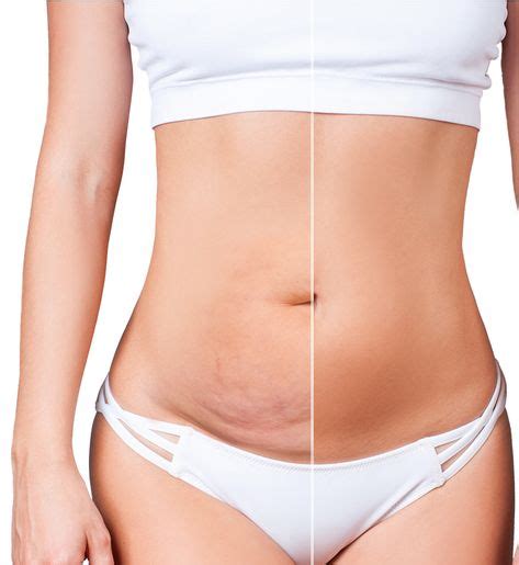 How Long Does It Take To Recover From A Tummy Tuck Tummy Tuck Recovery