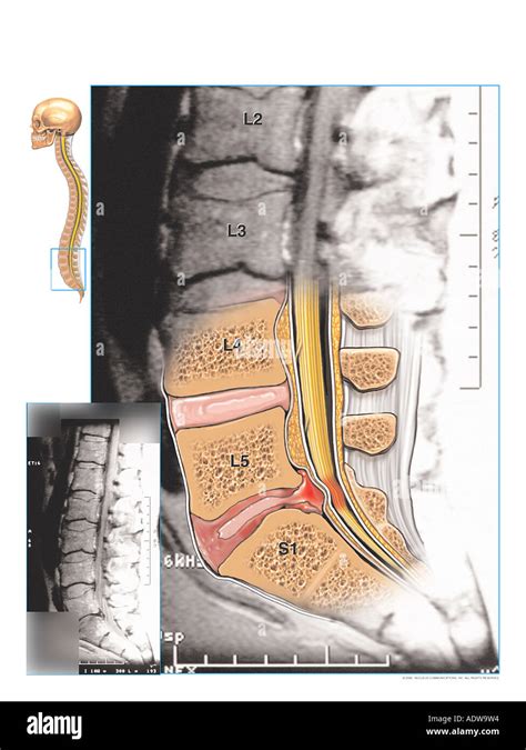 Lumbar Spine Illustration