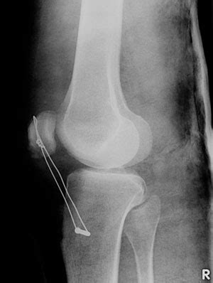 Der tfcc besteht neben dem diskus ulnokarpalis auch aus dem meniskus ulnokarpalis und den palmaren und dorsalen bandstrukturen (siehe schmidt/ lanz „ chirurgische anatomie der hand). Kniescheibenabriss-OP-Cerclage-seitlich — Kniespezialist ...