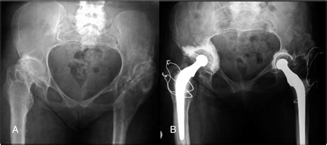 The Outcome Of 241 Charnley Total Hip Arthroplasties Performed By One