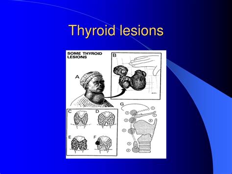 Ppt Thyroid Gland Powerpoint Presentation Free Download Id2133349