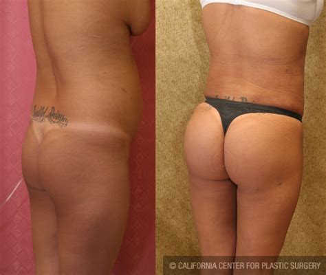 Patient Buttock Lift Augmentation Before And After Photos Encino Plastic Surgery Gallery