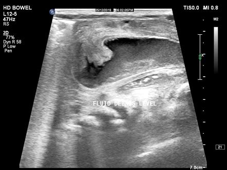 Imperforate Hymen In Newborn Image Radiopaedia Org