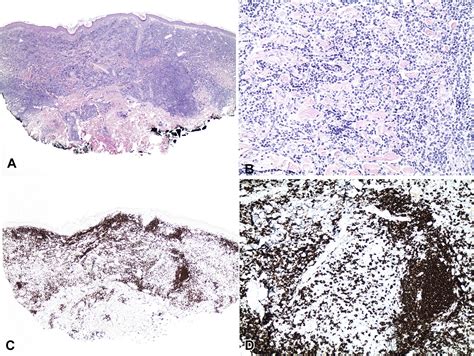 Dermoscopy Of Primary Cutaneous B Cell Lymphoma Pcbcl Journal Of