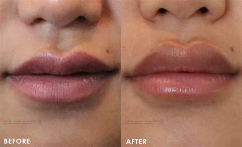 Lip Augmentation And Injections Sydney Bondi Dr Mooney