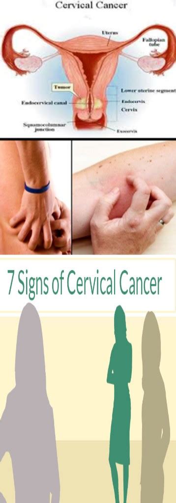 7 Signs Of Cervical Cancer Every Woman Must Know Yourhealthbodies