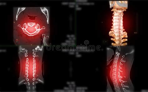 Ct Scan Of C Spine Or Cervical Spine Stock Illustration Illustration