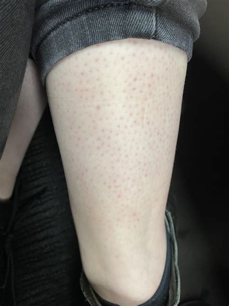 Skin Concerns Have Smoothed Out Keratosis Pilaris But Am Left With