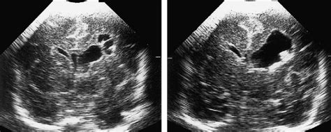 Case 2 Sequential Cranial Ultrasound Scans During The First Hours Of