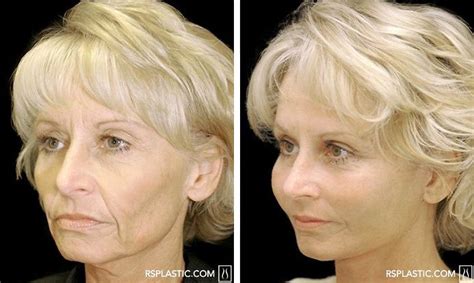 Before And After Photo Of A Face Lift Procedure Performed By Dallas
