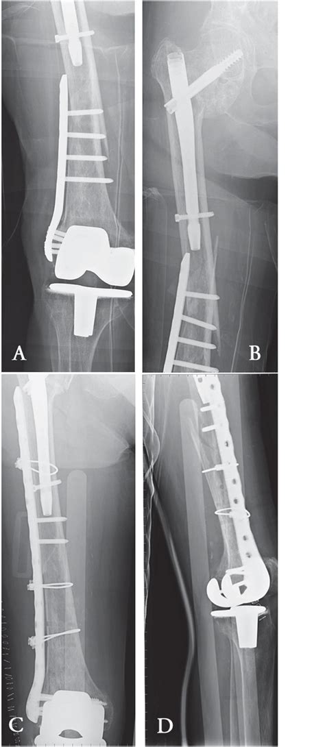 Femoral Shaft Fracture Occurring Between A Too Short Locking Plate