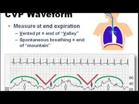 Finally, cvp analysis will be presented in mathematical formulations. cvp monitor - YouTube