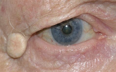Sebaceous Cyst Eyelid