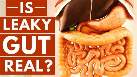 Is Leaky Gut Syndrome A Real Thing Youtube