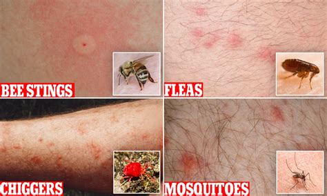 Mosquito Bites Vs Flea Bites