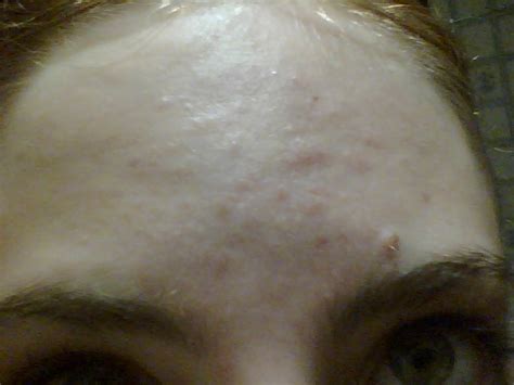 Bumps On Forehead After Sun Exposure General Acne Discussion