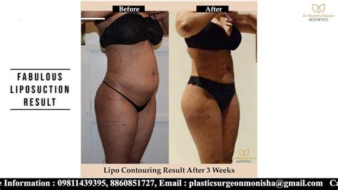 Get The Best Results Of Liposuction At Dr Monisha Kapoor Aesthetics Youtube