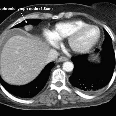 Pre Operative Ct Scan Demonstrating Enlarged Cardiophrenic Lymph Node