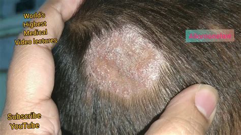 Fungal Infection Of The Scalp Tinea Capitis Causes Risk Factors Symptoms Diagnosis