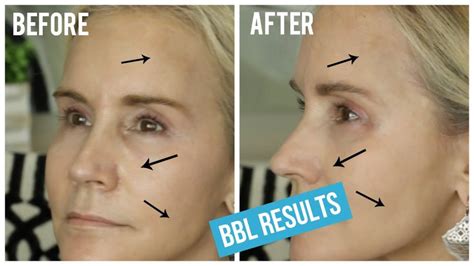 Bbl Face Treatment Transform Your Skin