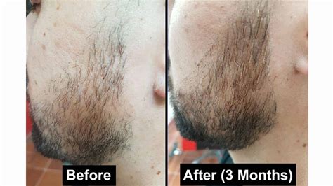 The best results usually come from users who've applied minoxidil for at least 1 year. Minoxidil Beard Treatments: Can It Really Grow a Better Beard?