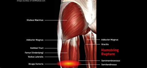 Upper leg muscles common names archives anatomy body. Hamstring Rupture - Thermoskin - Supports and braces for ...