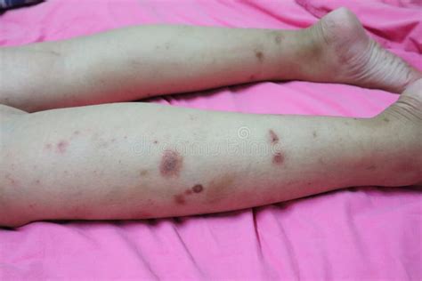 Close Up Of Skin On Legs Of Women With Skin Diseases Allergies Rash