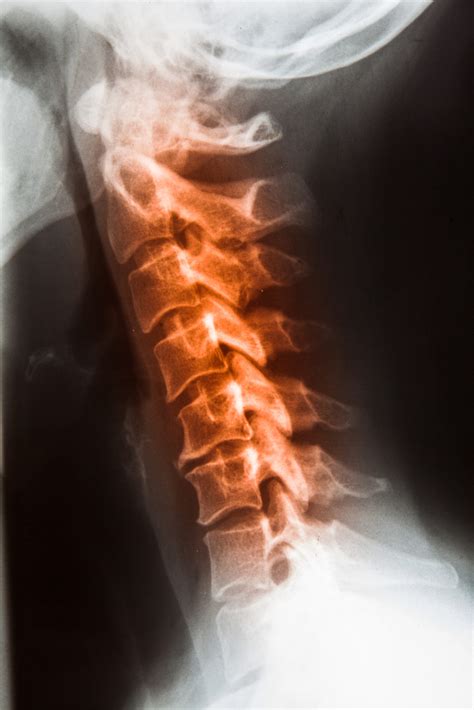 Chiropractic X Rays Why Do Chiropractors Take X Rays Integrative