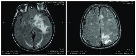 T2 Weighted Brain Mri From The Day Of Admission Presenting Multiple