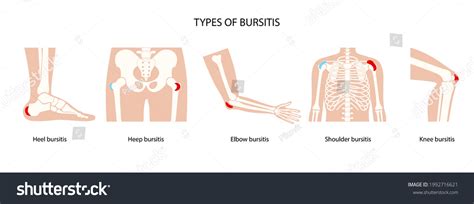 Common Types Bursitis Inflamed Bursa Human стоковая векторная графика