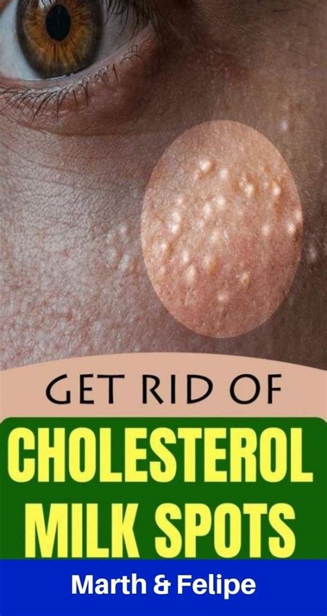 7 Remedies To Get Rid Of Cholesterol Milk Spots Naturally Skin