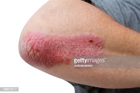 Psoriasis On A Mid Age Mans Elbow High Res Stock Photo Getty Images