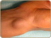 Les douleurs de la main peuvent avoir diverses origines : Kyste arthro-synovial - Institut Français de Chirurgie de ...