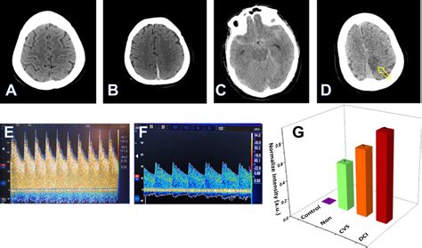 A Head Computed Tomography Ct Scan Of Healthy Patient B One Case Of