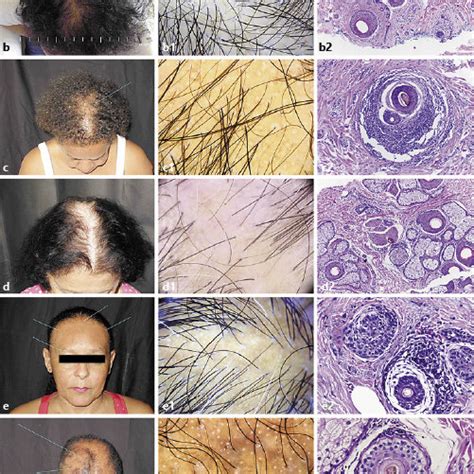 Histopathological Features Of The Scalp Biopsy Samples Download