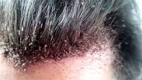 This Video Of A Mans Disgusting Head Lice Infestation Will Make Your