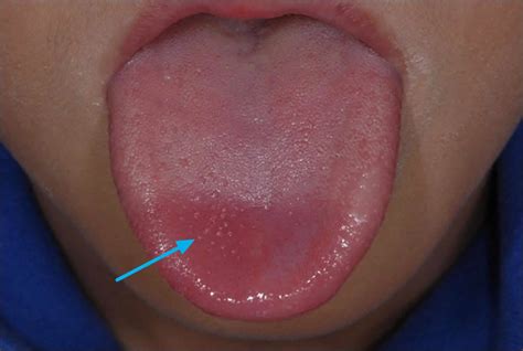 Causes Of White Bumps On Tongue Clearly