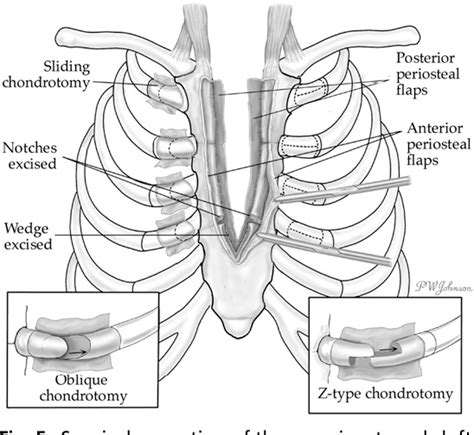 Figure 1 From Thoracic Defects Cleft Sternum And Poland Syndrome