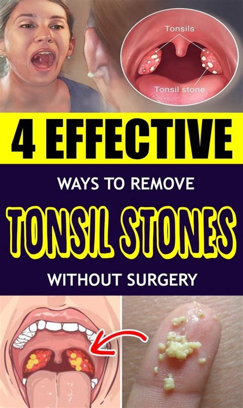 White Spots On Tonsils Causes