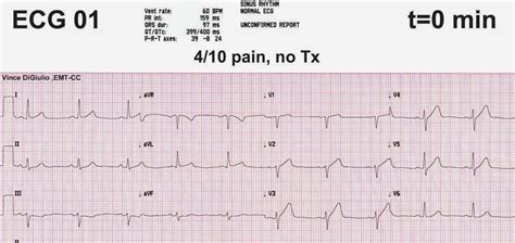 Dr Smiths Ecg Blog Incredible Case Demonstrating The