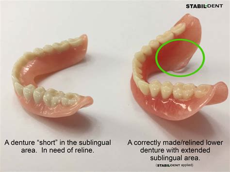 What You Need To Know To Get A Great Denture Reline