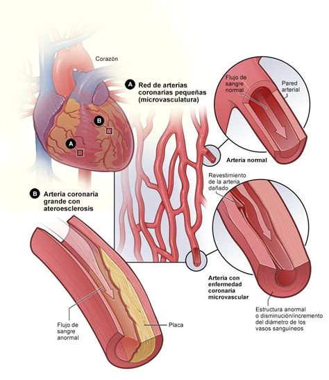 Cardiopatía coronaria Causas y factores de riesgo NHLBI NIH
