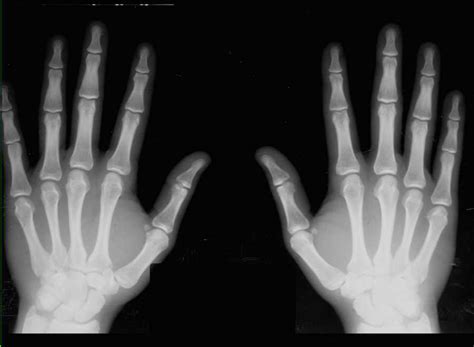 Normal Hands On X Ray X Rays Case Studies Ctisus Ct Scanning